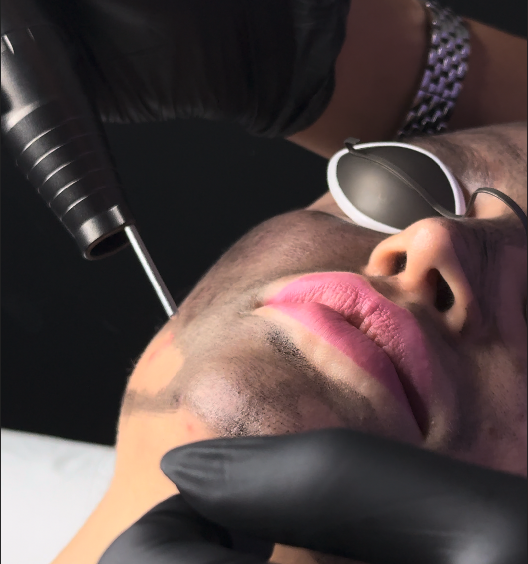 Rimozione Tattoo e Tatuaggio Sopracciglia