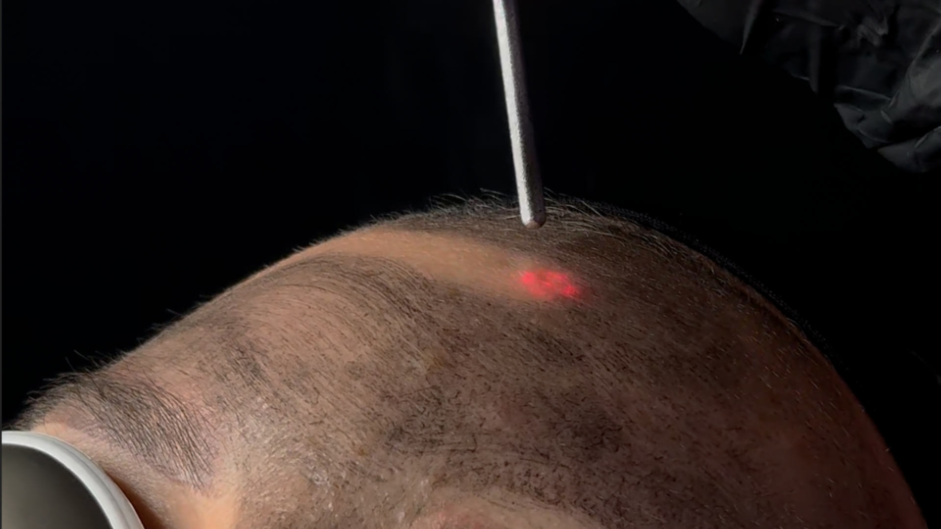 Hollywood Peel – Laser Hollywood Spectra