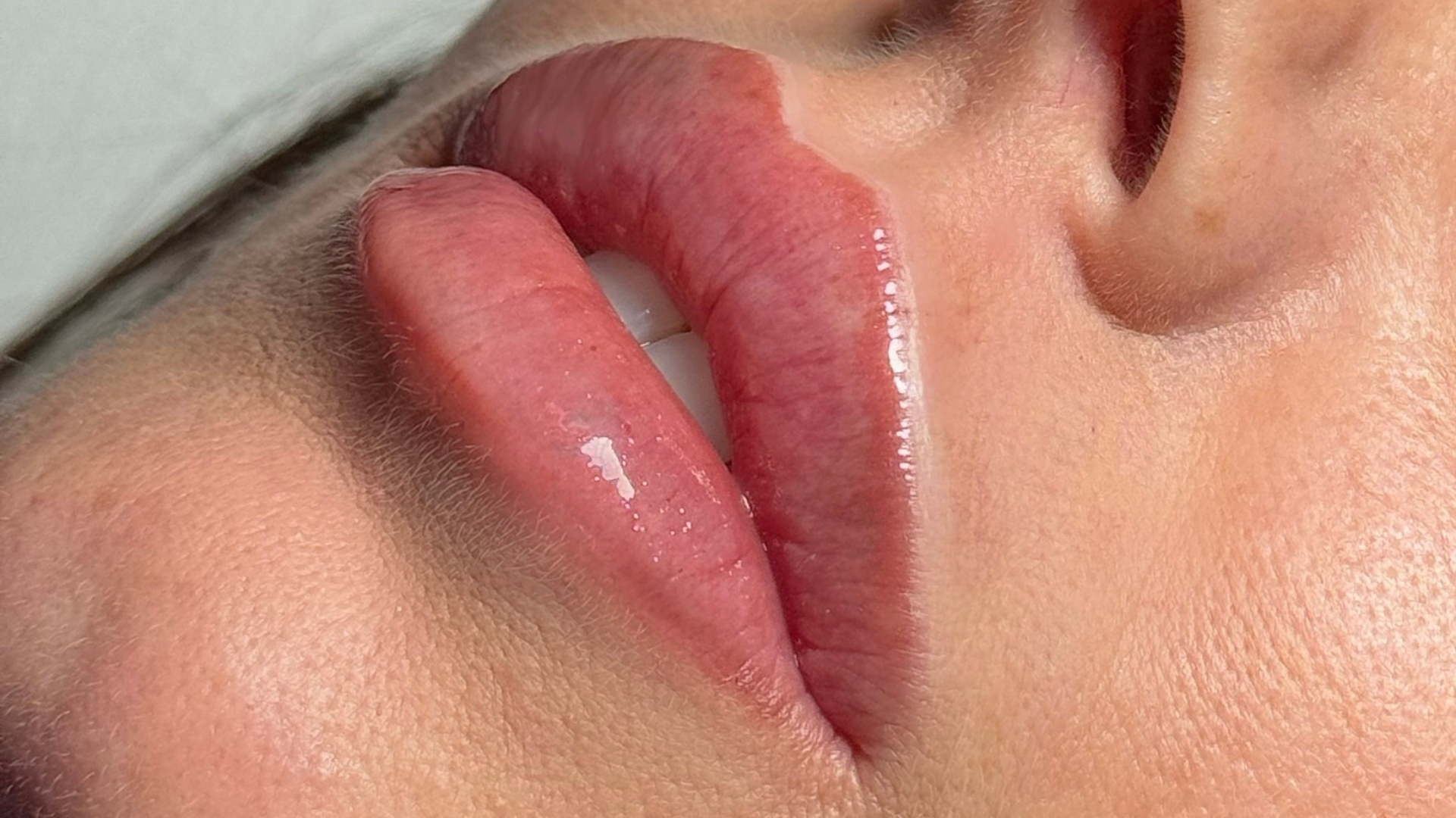 Filler Labbra – Labbra Piatte®️